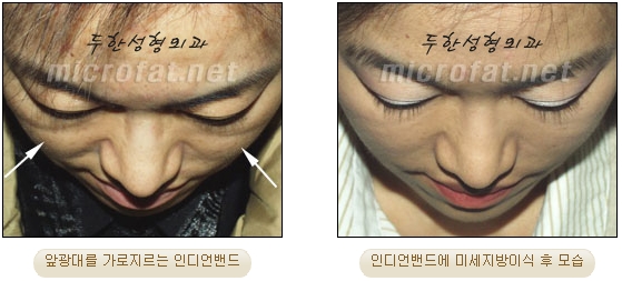 [Duhan Plastic Surgery Face Autologous Fat Grafting] - [Noble Surgery and Indian Band Fat Grafting] image 27