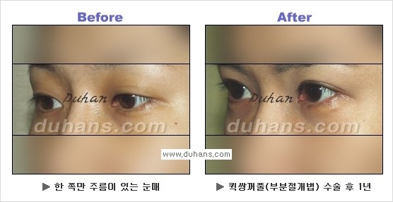 ​[두한성형외과 경쟁력 눈성형] - [자연스럽고 아름다운 쌍꺼풀의 기준] 관련 이미지 28