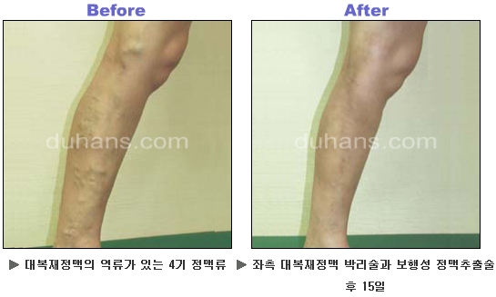 [두한성형외과 정맥류] - [하지정맥류, 정맥확장증, 혈관확장증] 관련 이미지 36