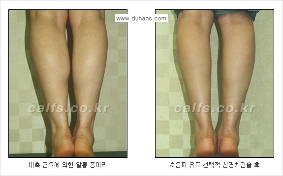 ​[두한성형외과와 날씬한 종아리 만들기!] - [간편하고 안전한 종아리 축소방법 ④] 관련 이미지 14