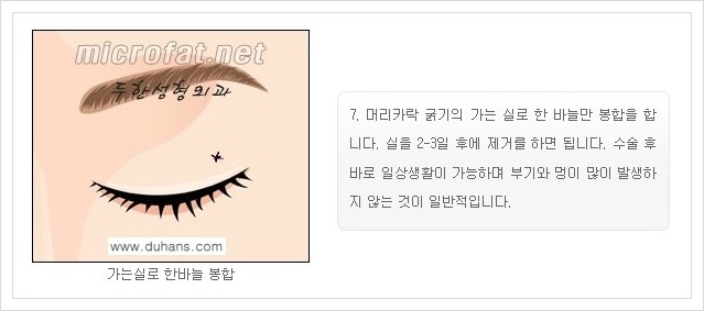 [두한성형외과 경쟁력 지방제거] - [눈 지방제거 안내] 관련 이미지 9