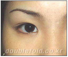 [Dohan Plastic Surgery Double Eyelid Surgery] - [Beautiful Double Eyelids] image 4