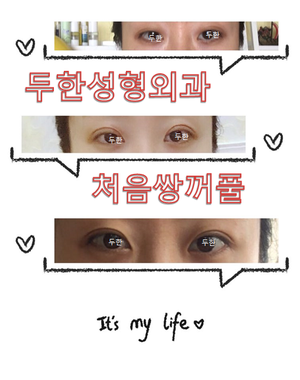 [Double Eyelid Surgery Duhan Plastic Surgery] - [Buried Method, Incision Method, Partial Incision Method] image 32
