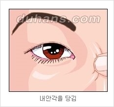 쌍커풀수술 두한성형외과 - 나에게 맞는 눈성형은? 관련 이미지 52