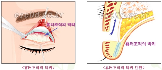 [두한성형외과 쌍꺼풀재수술] - [쌍꺼풀재수술성공요건, 쌍꺼풀재수술과정] 관련 이미지 5