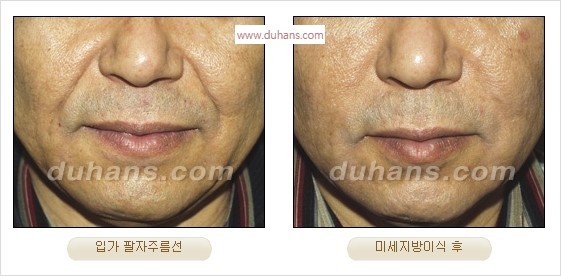 [두한성형외과 경쟁력 주름성형] - [간단하고 부작용 없는 자연스러운 주름제거 방법] 관련 이미지 26