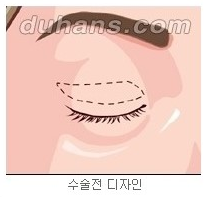 [두한성형외과 안검성형] - [상안검, 하안검] 관련 이미지 1