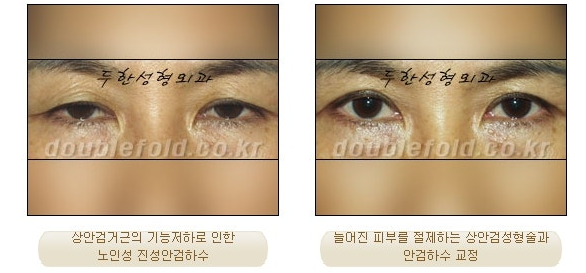 과교정 눈매 (소세지 쌍커풀 재수술, 눈매교정 재수술) 관련 이미지 10