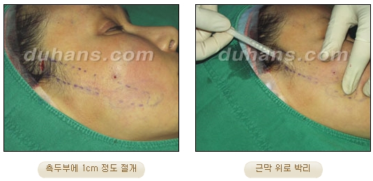 [Duhan Plastic Surgery Wrinkle Removal] - [Wrinkle Removal Treatment Methods] image 41