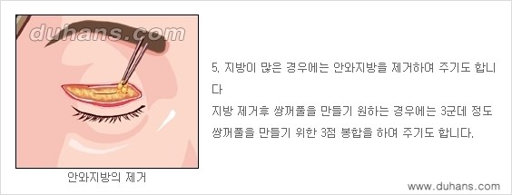 [두한성형외과 경쟁력 눈성형] - [상큼하고 환한 젊은 눈매 상안검성형(윗눈꺼풀 처짐) 안내] 관련 이미지 5