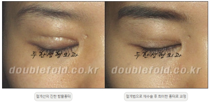 [Double Eyelid Surgery Duhan Plastic Surgery] - [Revision Methods] image 41