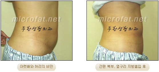 두한성형외과 지방흡입 - 부위별 안전 지방흡입 관련 이미지 21