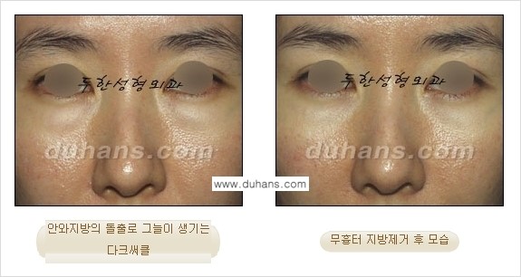 [두한성형외과 젊은 눈매 안검성형] - [눈밑 지방제거의 수술 전후 안내 ②] 관련 이미지 4