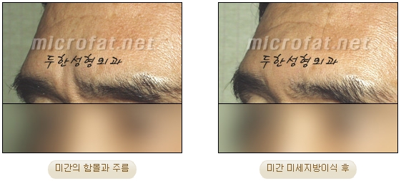 [두한성형외과 자가지방이식] - [미세지방이식 안내] 관련 이미지 10