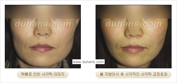 [두한성형외과 경쟁력 미세지방이식] - [볼살, 이마, 측두부 - 안면윤곽 미세지방이식] 관련 이미지 15