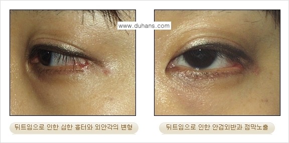 [두한성형외과 경쟁력 눈성형] - [뒤트임 수술 안내] 관련 이미지 5