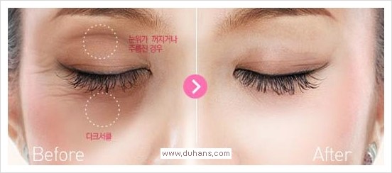 [두한성형외과 경쟁력 눈밑 다크써클 치료] - [눈밑 다크써클과 눈위 지방이식 콤비 프로그램 안내] 관련 이미지 1