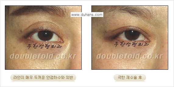 [두한성형외과 쌍꺼풀 재수술, 극한 눈재수술] - [재수술에 대한 자주하는 질문과 답변 안내] 관련 이미지 15