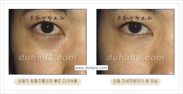 [두한성형외과 경쟁력 눈밑성형] - [꺼진 눈밑, 눈밑 함몰 주름선 눈밑 미세지방이식 안내] 관련 이미지 13