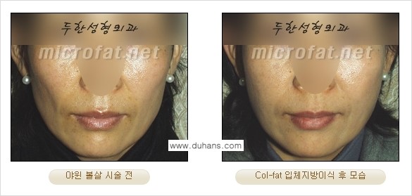 [두한성형외과 경쟁력 미세지방이식] - [Col-fat(콜펫) 지방이식의 특징과 차이점 안내] 관련 이미지 9