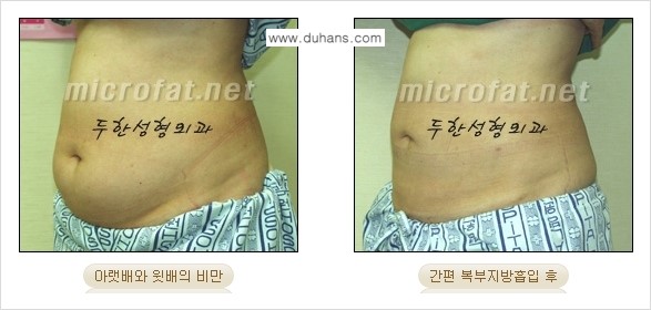 [두한성형외과 겨울엔 지방흡입] - [간편한 복부지방흡입 도전 2.] 관련 이미지 2