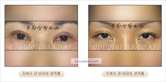 [두한성형외과 경쟁력 눈성형] - [비대칭 쌍꺼풀 라인의 여러 가지 교정 방법] 관련 이미지 2