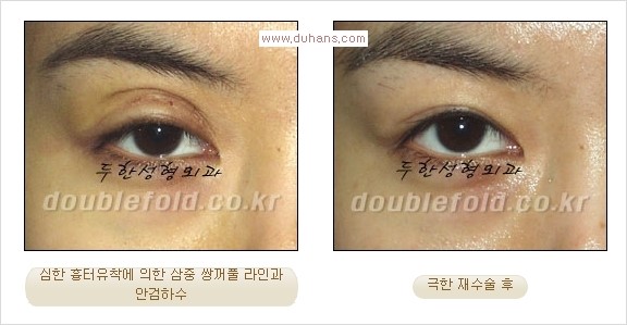 Dr. 컬럼 - 쌍꺼풀 재수술의 부작용을 최소화하는 극한 눈재수술 관련 이미지 3