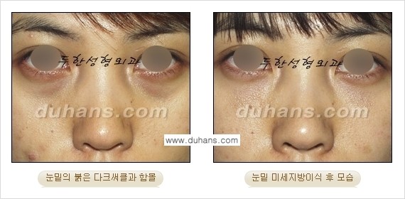 [두한성형외과 상큼하고 환한 눈매완성] - [눈밑 미세지방이식 ①] 관련 이미지 4