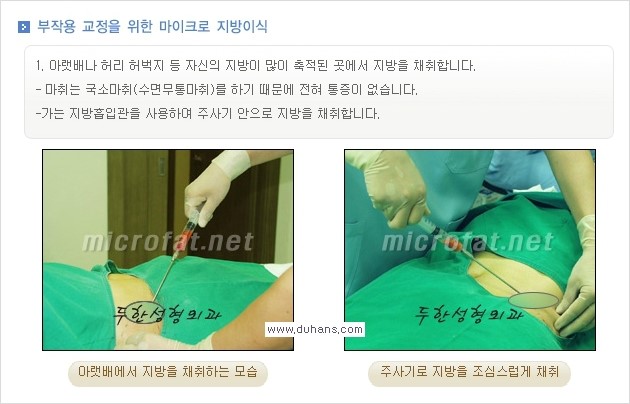 [두한성형외과 경쟁력 미세지방이식] - [타 병원에서 볼살 지방이식 이후 부작용 교정 방법 안내] 관련 이미지 19