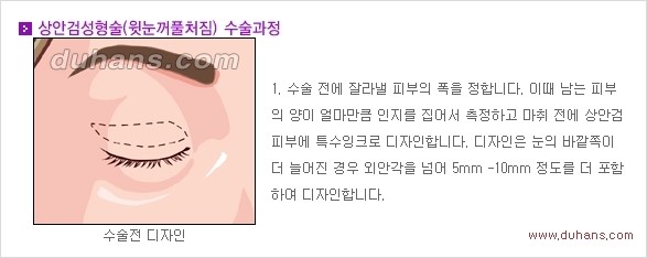 [두한성형외과 경쟁력 안검성형] - [젊고 아름다운 눈매 상안검 성형술 안내] 관련 이미지 1