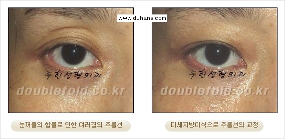[두한성형외과 경쟁력 눈성형] - [삼중(세겹) 쌍꺼풀 라인의 교정] 관련 이미지 18