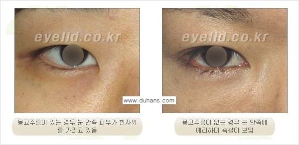 [두한성형외과 경쟁력 눈성형] - [안검하수와 몽고주름에 대한 자주하는 질문과 답변] 관련 이미지 14