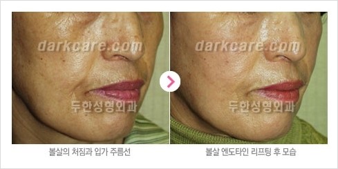 [두한성형외과 경쟁력 주름성형] - [주름제거를 위한 리프팅] 관련 이미지 26