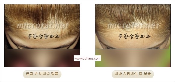 [두한성형외과 경쟁력 동안성형 리더] - ​[미간주름, 이마주름, 안검성형, 이마거상술, 눈썹거상술] 관련 이미지 36