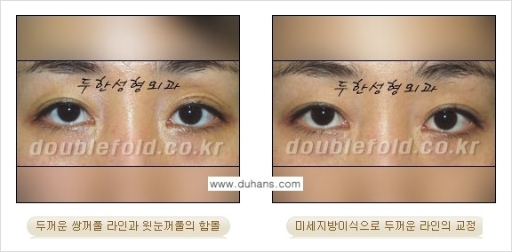 [두한성형외과 경쟁력 눈성형] - [미세지방이식으로 두꺼운 쌍꺼풀 라인의 교정 방법 안내] 관련 이미지 12