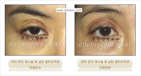 [두한성형외과 경쟁력 쌍꺼풀 재수술 스페셜] - [망가진 라인을 교정하는 극한 재수술] 관련 이미지 3