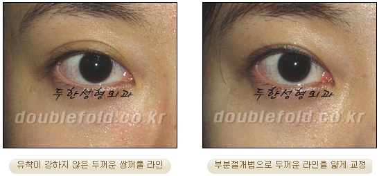 [두한성형외과 쌍커풀수술] - [눈성형 방법에 대한 자주하는 질문과 답변] 관련 이미지 15