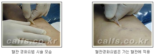 ​[두한성형외과 종아리성형] - [나에게 맞는 종아리시술] 관련 이미지 27