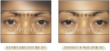 [두한성형외과 쌍커풀수술] - [쌍꺼풀지방이식] 관련 이미지 33