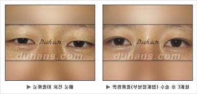Best Place for Double Eyelid Revision Surgery, Duhan Plastic Surgery - Partial Incision Eye Revision Surgery image 26