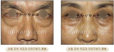 [두한성형외과 안검성형] - [상안검, 하안검] 관련 이미지 14