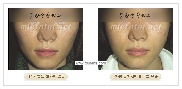 [두한성형외과 경쟁력 윤곽성형] - [볼, 볼살 지방이식] 관련 이미지 16
