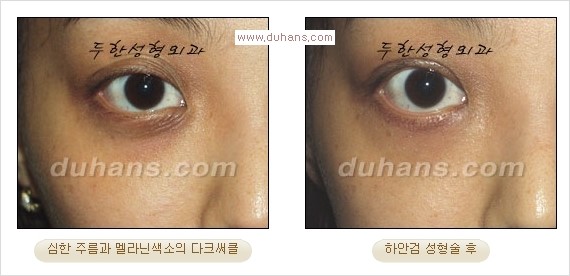 [두한성형외과 경쟁력 다크써클 교정] - [젊어 보이면서 개선된 인상을 주는 하안검 성형술] 관련 이미지 17