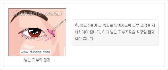 [두한성형외과 경쟁력 눈성형] - [앞트임 수술(몽고주름 제거) 안내 ②] 관련 이미지 6