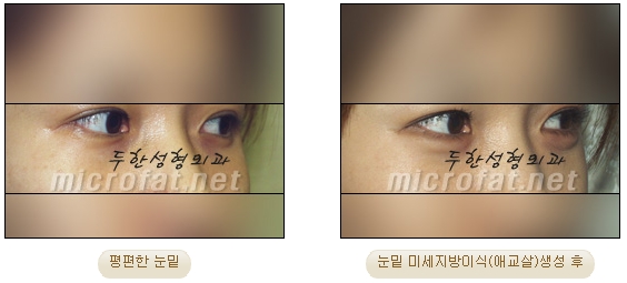 [두한성형외과 자가지방이식] - [미세지방이식 안내] 관련 이미지 12