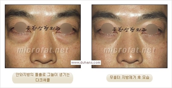 [두한성형외과 경쟁력 눈밑성형] - [과도한 눈밑지방제거의 부작용 후 눈밑지방재배치] 관련 이미지 17