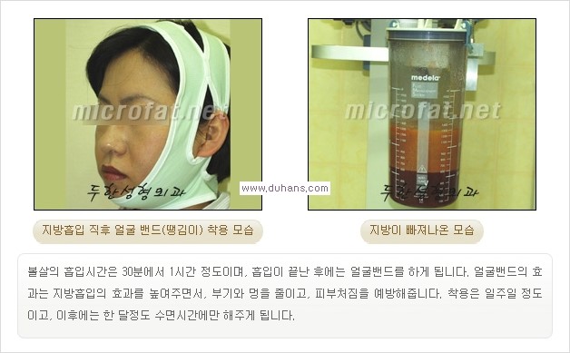 ​​[두한성형외과 경쟁력 지방흡입] - [아름다운 얼굴 윤곽선을 위한  볼살지방흡입, 턱선지방흡입 안내] 관련 이미지 7