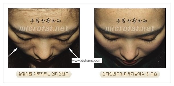 [두한성형외과 경쟁력 미세지방이식] - [귀족수술과 인디언밴드(앞광대주름) 미세지방이식] 관련 이미지 19