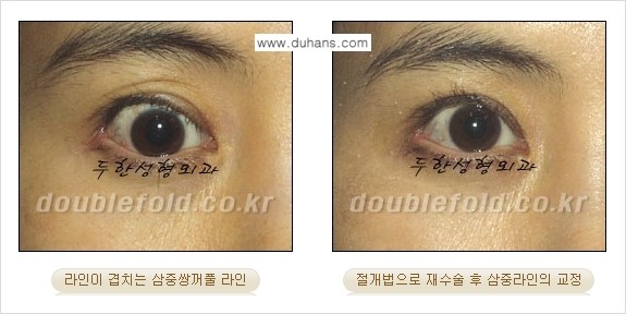 ⁠[두한성형외과 경쟁력 쌍꺼풀 재수술, 극한 눈재수술] - [삼중(세겹) 쌍꺼풀 라인의 교정] 관련 이미지 4