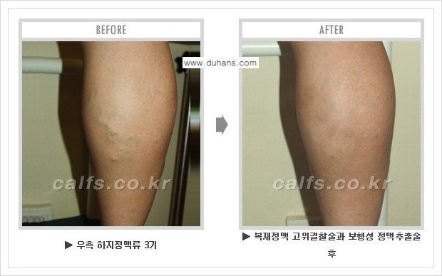 [두한성형외과 경쟁력 정맥류 치료] - [하지정맥류 사진 자료 안내 1.] 관련 이미지 8